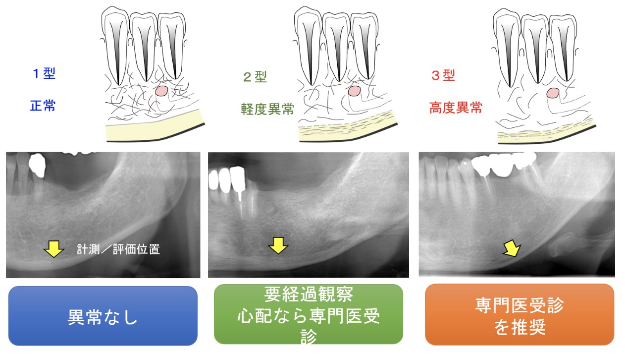 歯科でも骨粗しょう症のスクリーニングができる⁉